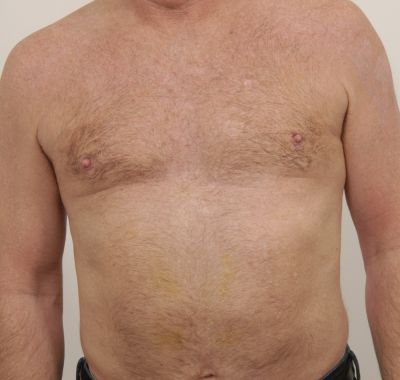 After Image: Male Breast Reduction - front