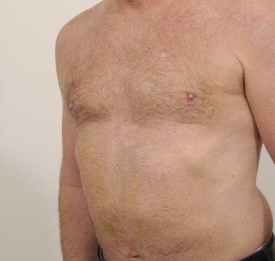 After Image: Male Breast Reduction - left-front-oblique
