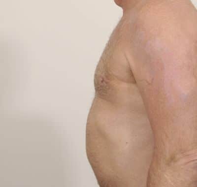 After Image: Male Breast Reduction - left-side