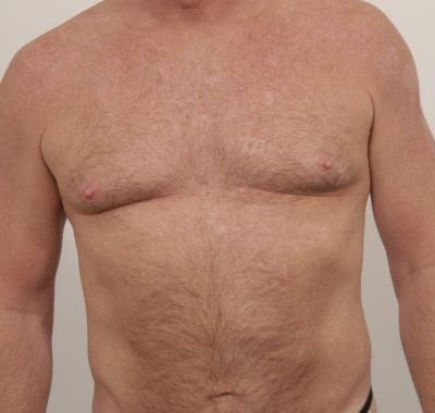 Before Image: Male Breast Reduction - front