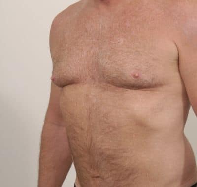 Before Image: Male Breast Reduction - left-front-oblique