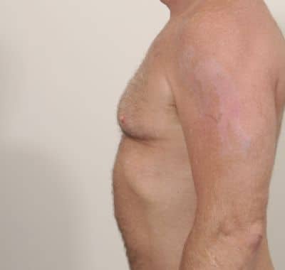 Before Image: Male Breast Reduction - left-side