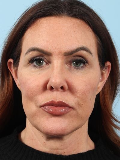 After Image: Necklift - front