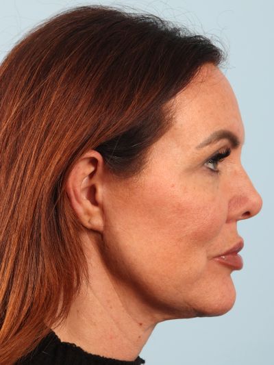 After Image: Necklift - right-side