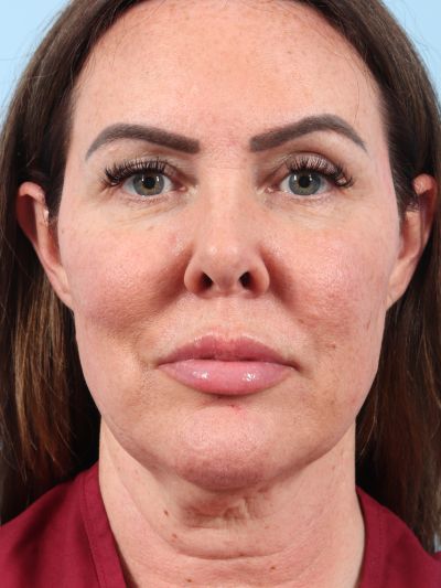 Before Image: Necklift - front