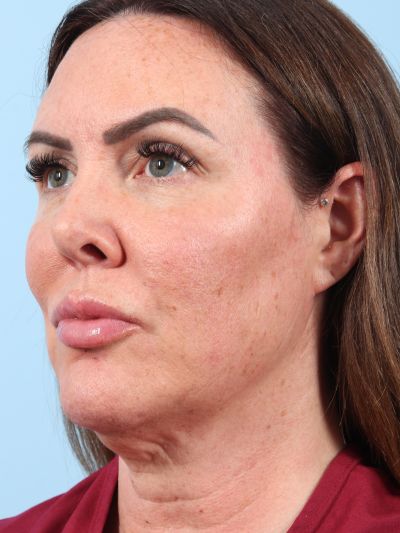 Before Image: Necklift - left-front-oblique