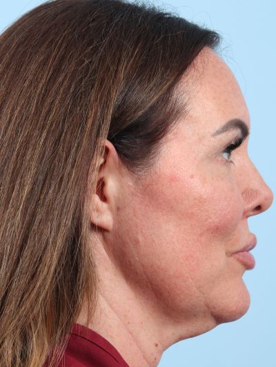 Before Image: Necklift - right-side