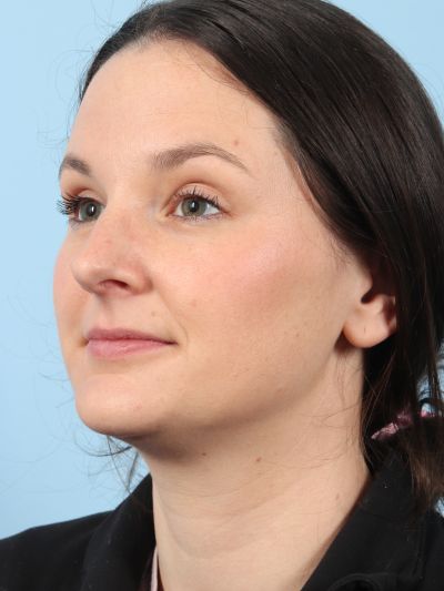 After Image: Necklift - left-front-oblique