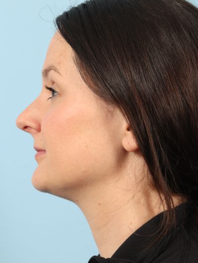 After Image: Necklift - left-side