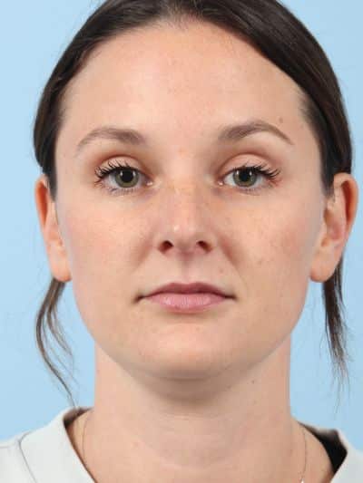 Before Image: Necklift - front