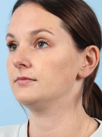 Before Image: Necklift - left-front-oblique