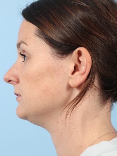 Before Image: Necklift - left-side