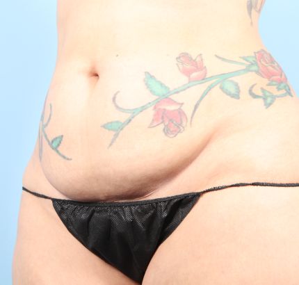 Before Image: Tummy Tuck - left-front-oblique