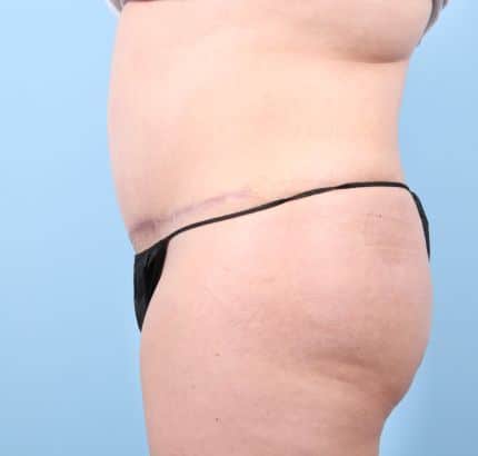 After Image: Tummy Tuck - left-side