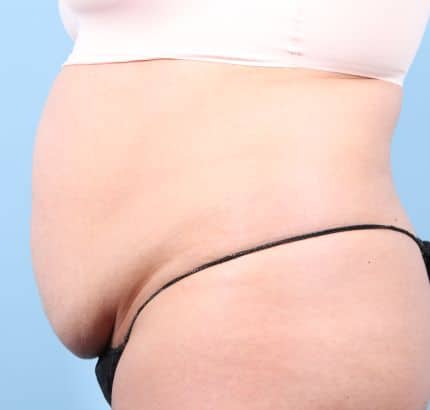 Before Image: Tummy Tuck - left-side