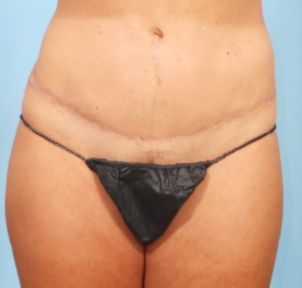 After Image: Tummy Tuck - front
