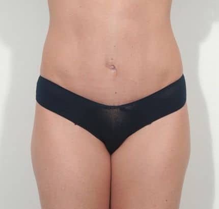 After Image: Tummy Tuck - front
