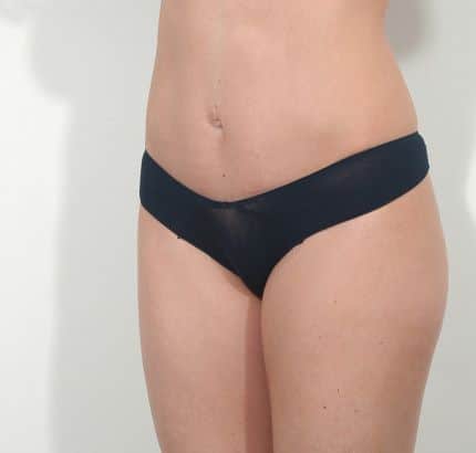 After Image: Tummy Tuck - left-front-oblique