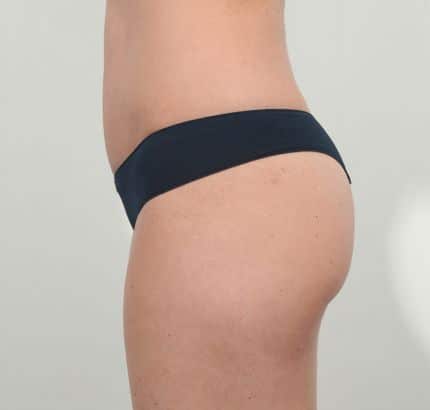 After Image: Tummy Tuck - left-side