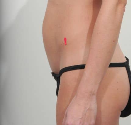 Before Image: Tummy Tuck - left-side