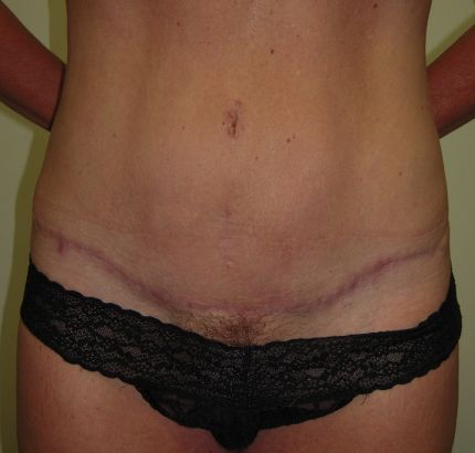 After Image: Tummy Tuck - front