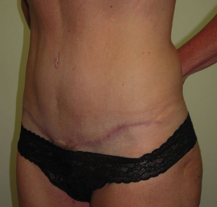 After Image: Tummy Tuck - left-front-oblique