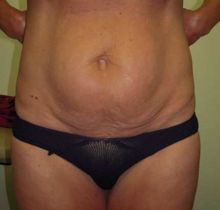Before Image: Tummy Tuck - front