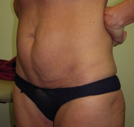 Before Image: Tummy Tuck - left-front-oblique