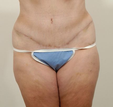 After Image: Tummy Tuck - front
