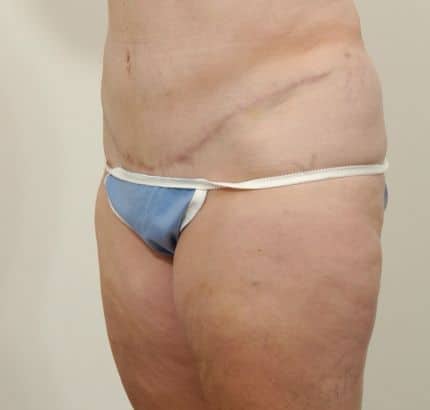 After Image: Tummy Tuck - left-front-oblique