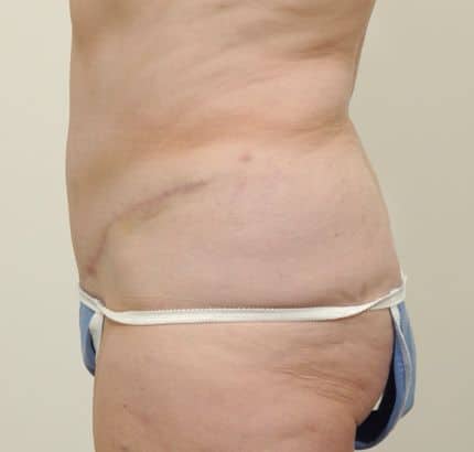 After Image: Tummy Tuck - left-side