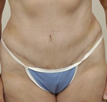 After Image: Tummy Tuck - front