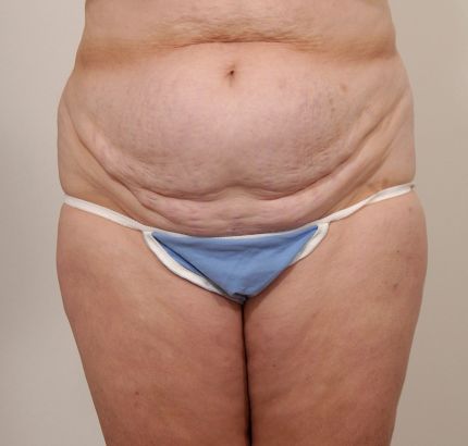 Before Image: Tummy Tuck - front