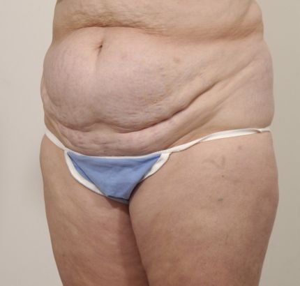 Before Image: Tummy Tuck - left-front-oblique