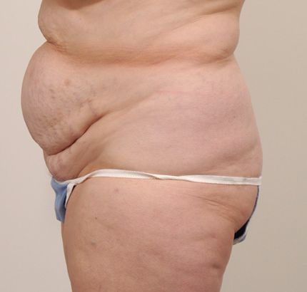 Before Image: Tummy Tuck - left-side