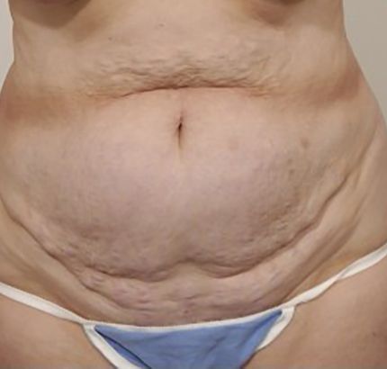 Before Image: Tummy Tuck - front