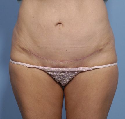 After Image: Tummy Tuck - front