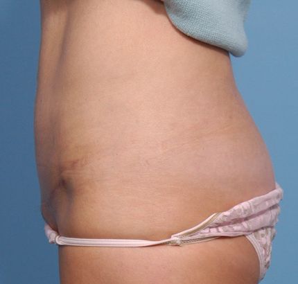 After Image: Tummy Tuck - left-side