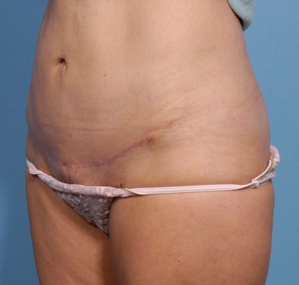 After Image: Tummy Tuck - left-front-oblique