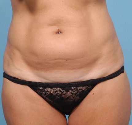 Before Image: Tummy Tuck - front