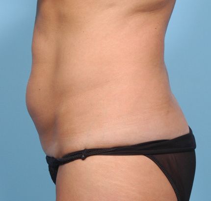 Before Image: Tummy Tuck - left-side