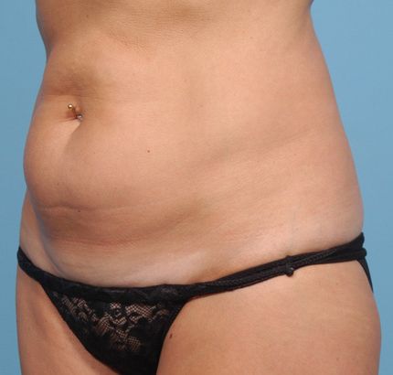 Before Image: Tummy Tuck - left-front-oblique