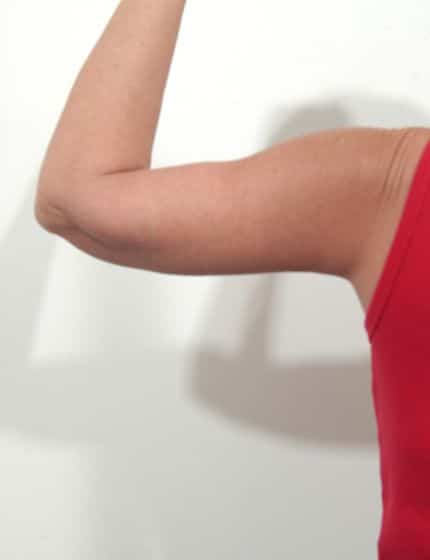 After Image: Arm Lift - front