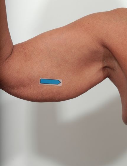 Before Image: Arm Lift - front