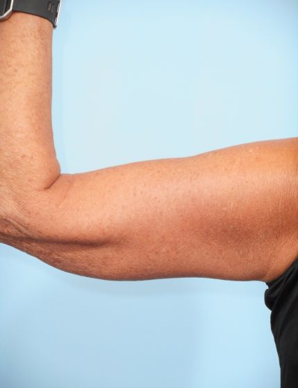 After Image: Arm Lift - front