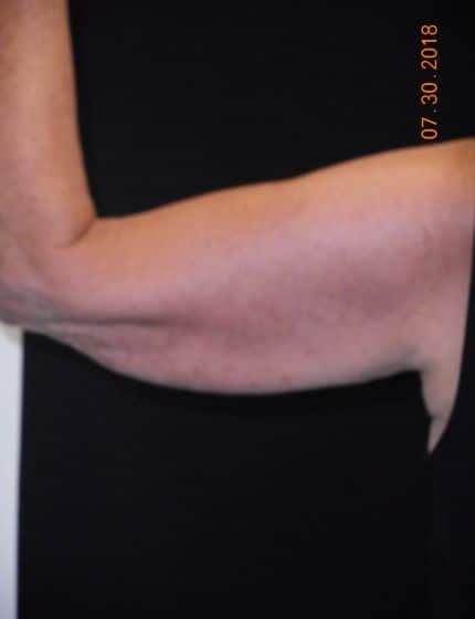 Before Image: Arm Lift - front