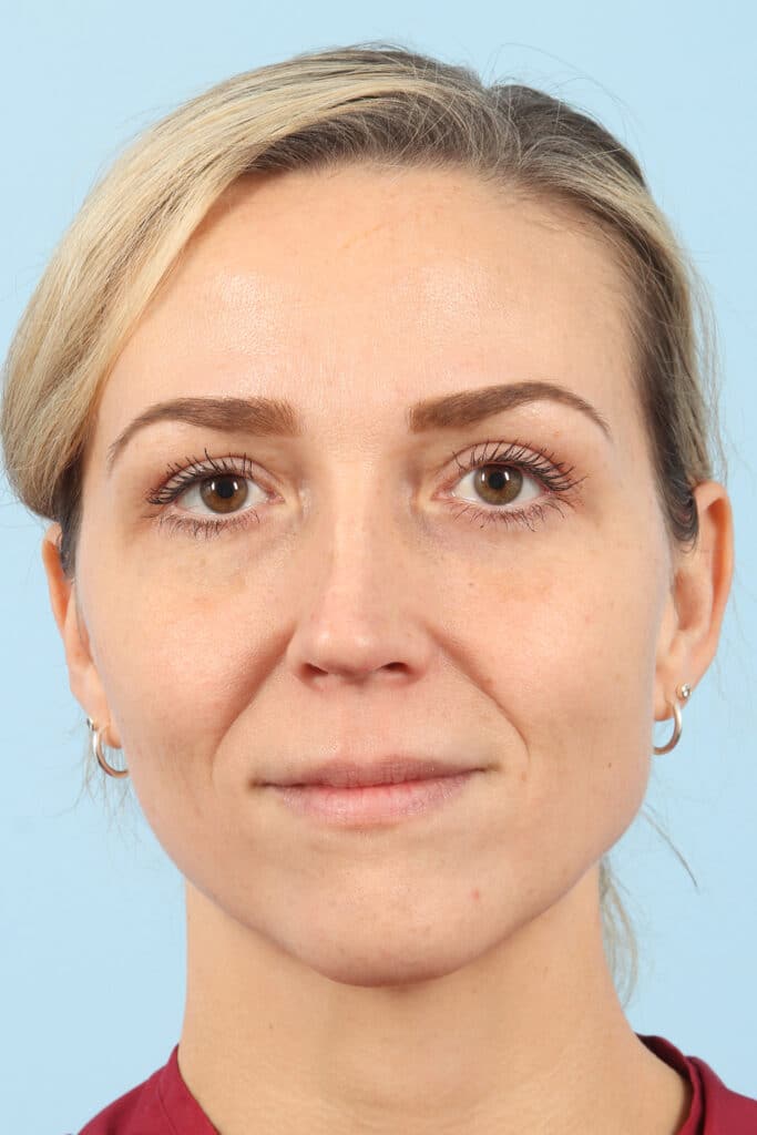 After Image: Eyelift - front