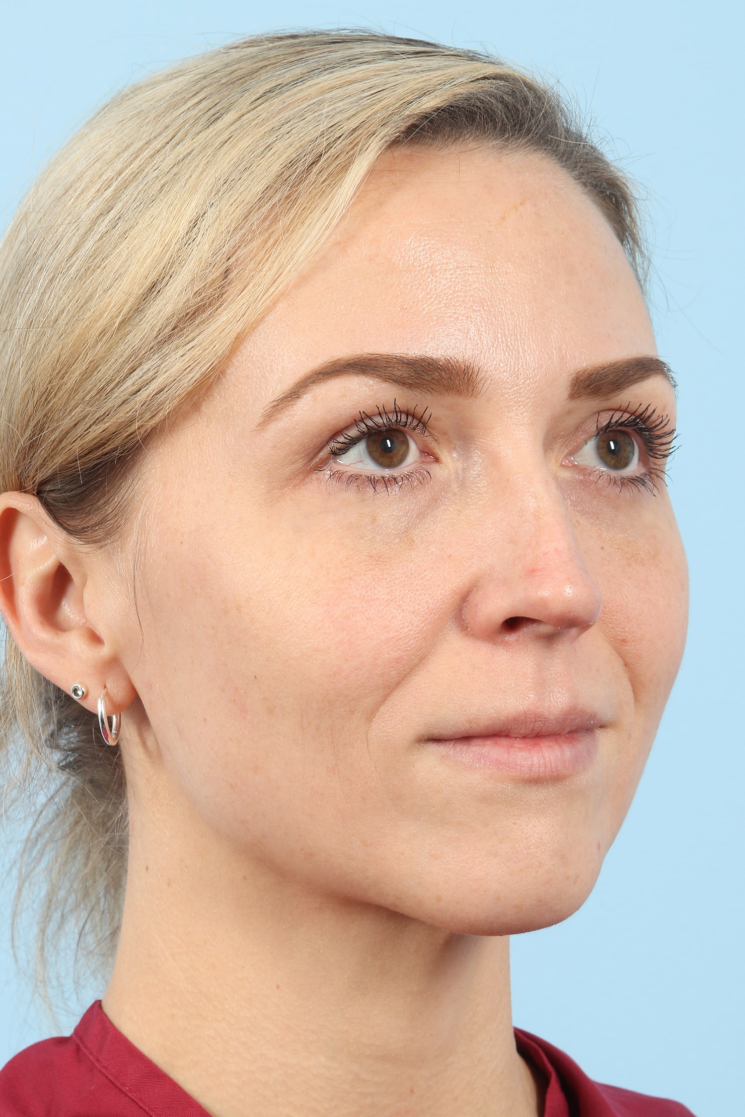 After Image: Eyelift - right-front-oblique