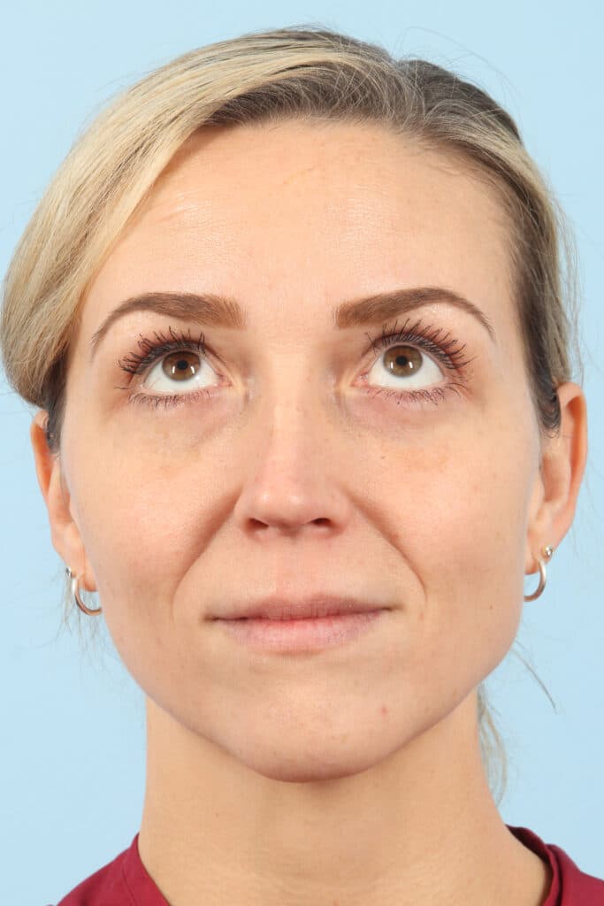 After Image: Eyelift - front