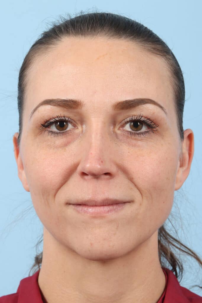 Before Image: Eyelift - front